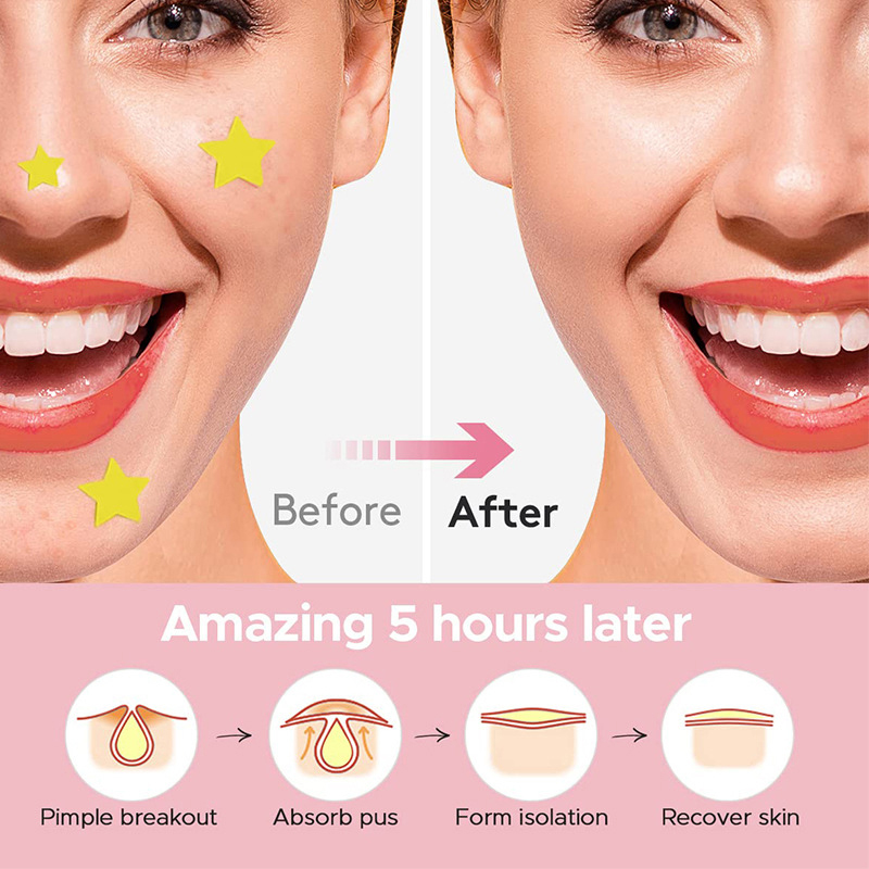 600Pcs/set Star Pimple Patch A - đánh giá và giá Skincare
